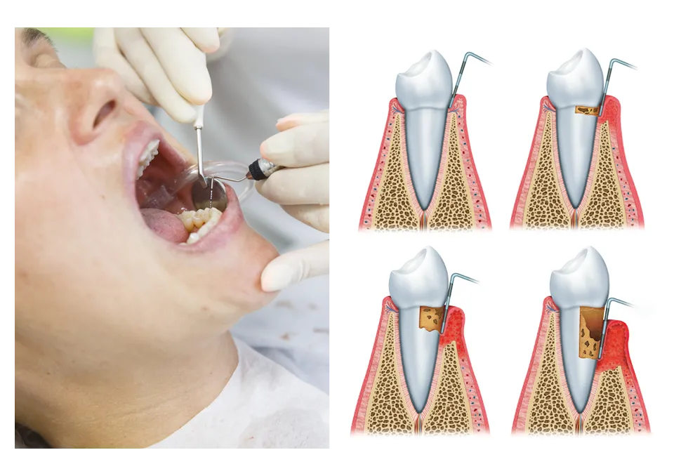 scaling and root planing therapy