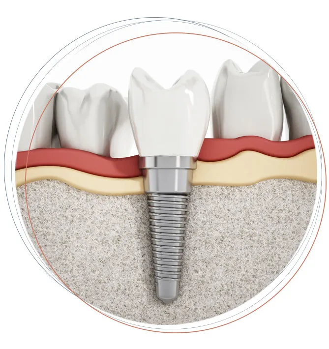 bone graft for dental imaplnt model