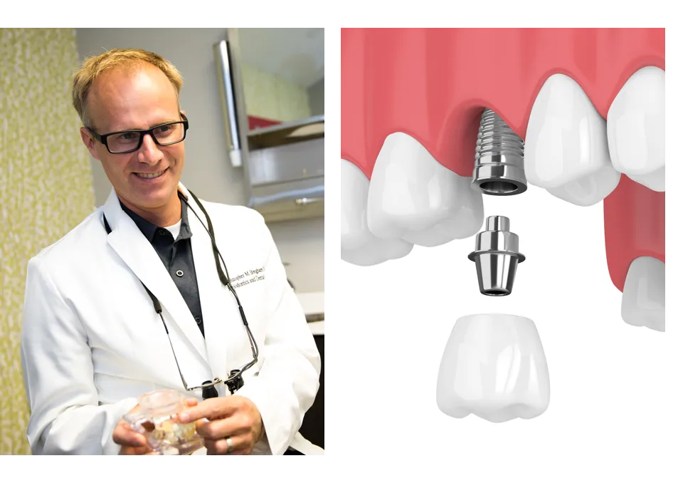 bone graft in the upper jaw for dental imaplnts