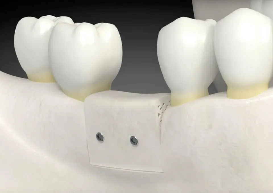 bone grafting model