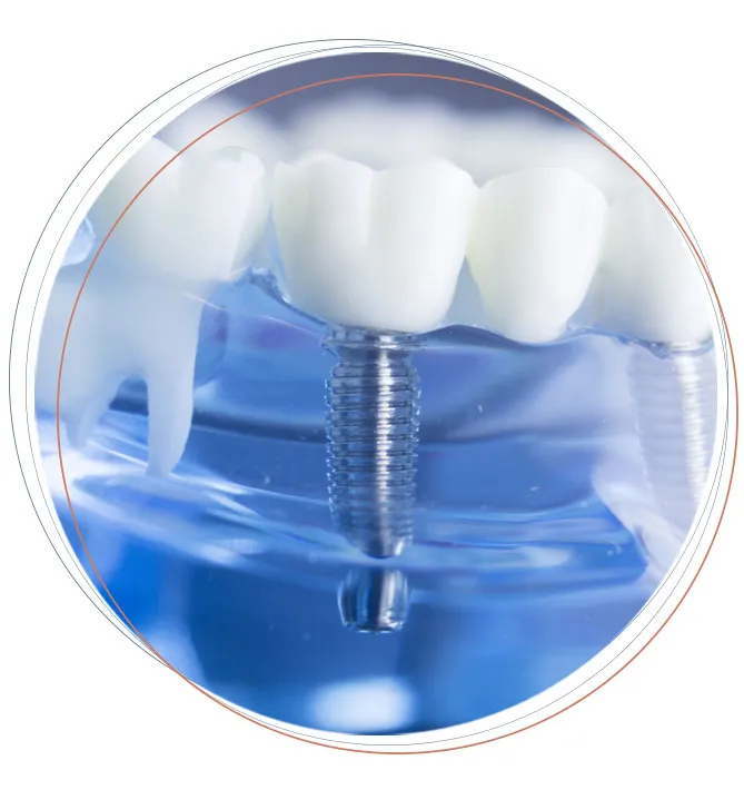 dental implants model 1