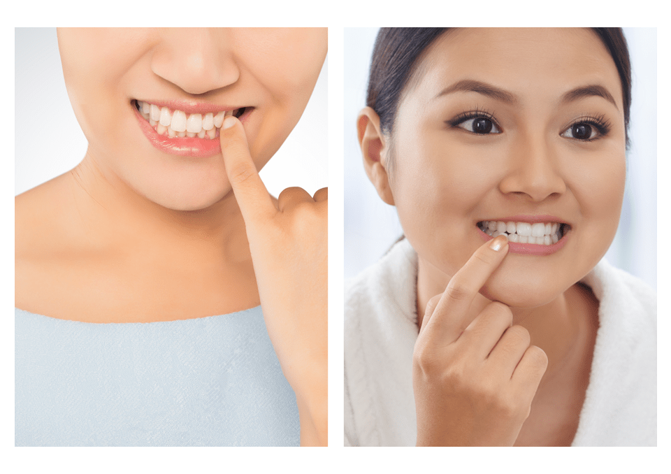 dental patient showing results of gingivectomy treatment