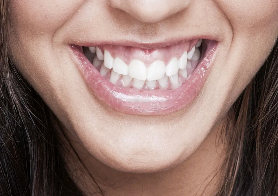 dental patient with gummy smile in need of crown lengthening