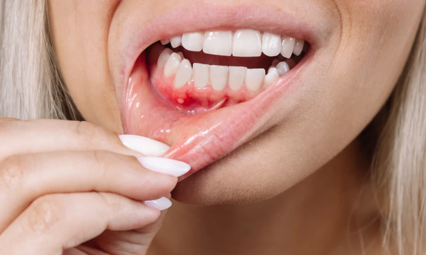 gum disease