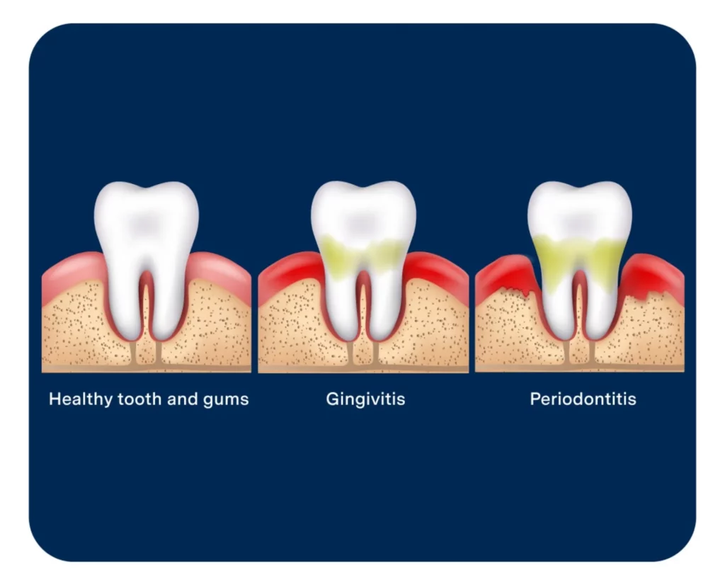 Illustration showing the progression of gum disease: a healthy tooth with pink gums, a tooth with gingivitis showing mild inflammation and plaque buildup, and a tooth with periodontitis featuring gum recession and bone loss.