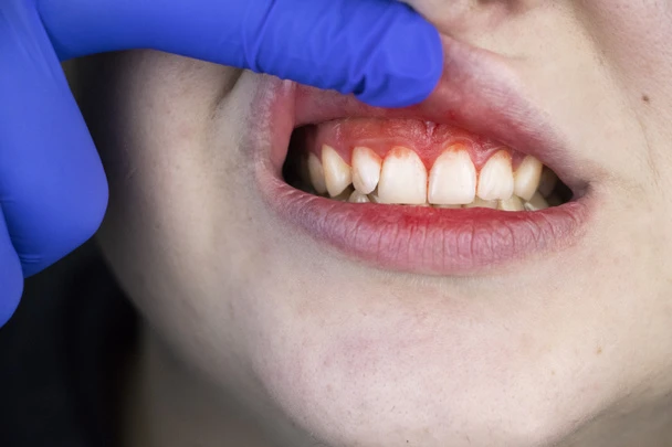 Close-up of inflamed gums during a dental exam, showing early signs of periodontal disease—a reminder that gum health is essential to preserving your smile and overall well-being.
