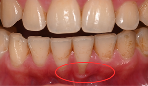 gum graft 1a 0
