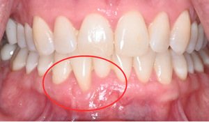 gum graft 1d 1