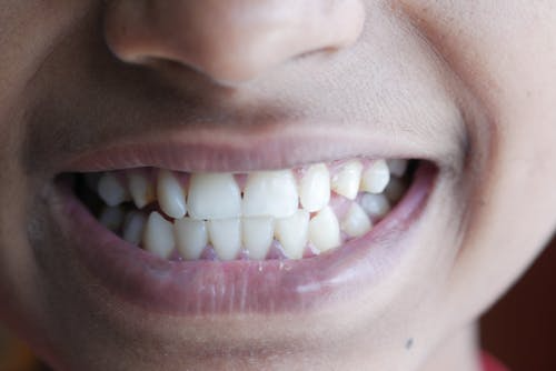photo of a person's teeth